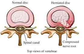 Chiropractic Concord CA Disc Diagram